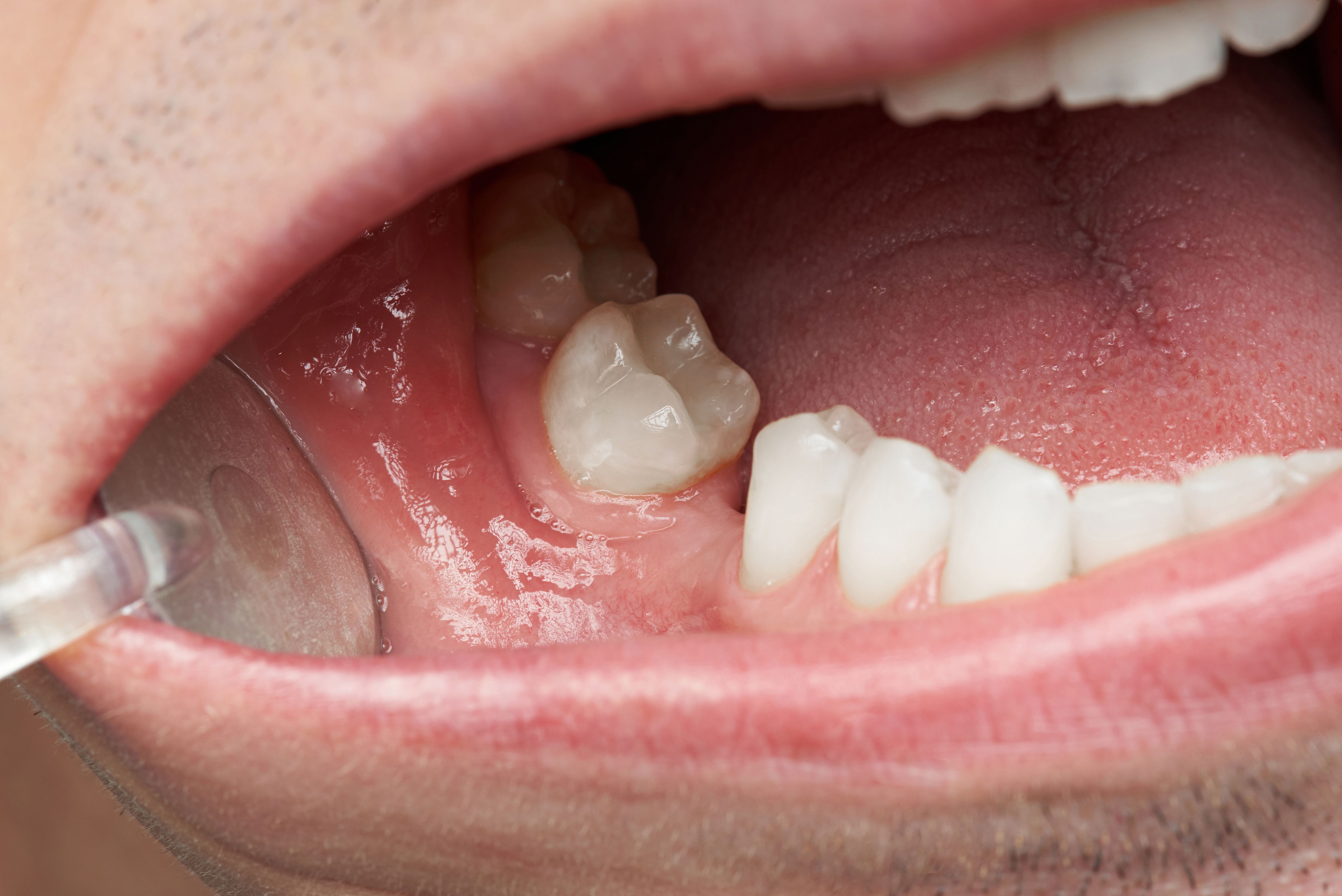 Smile with missing tooth