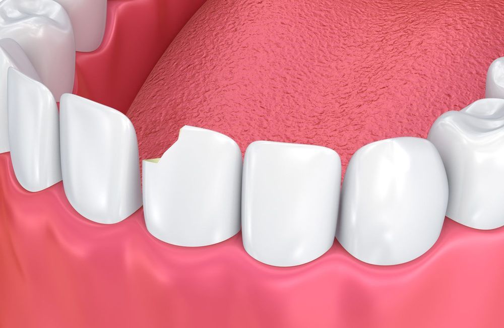 Illustration of chipped tooth