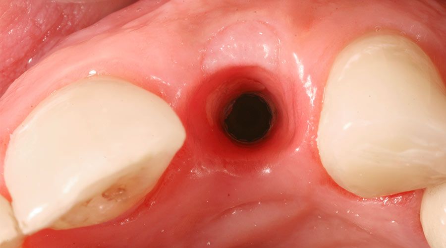 tooth socket