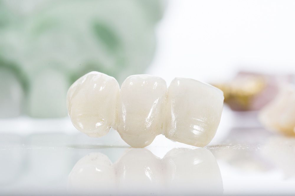 The Structure of a Dental Bridge