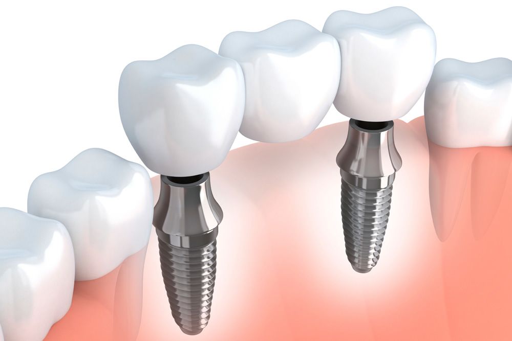 How an Implant-Supported Bridge Works