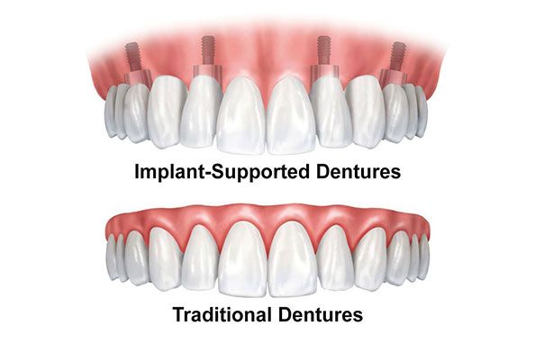 Illustration of traditional vs. implant-supported denture