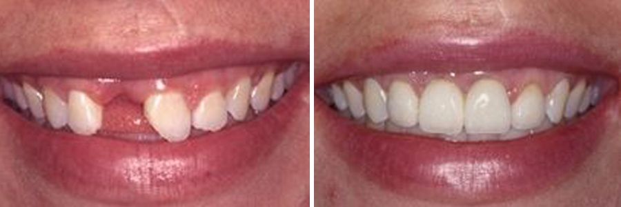 dental implants before and after