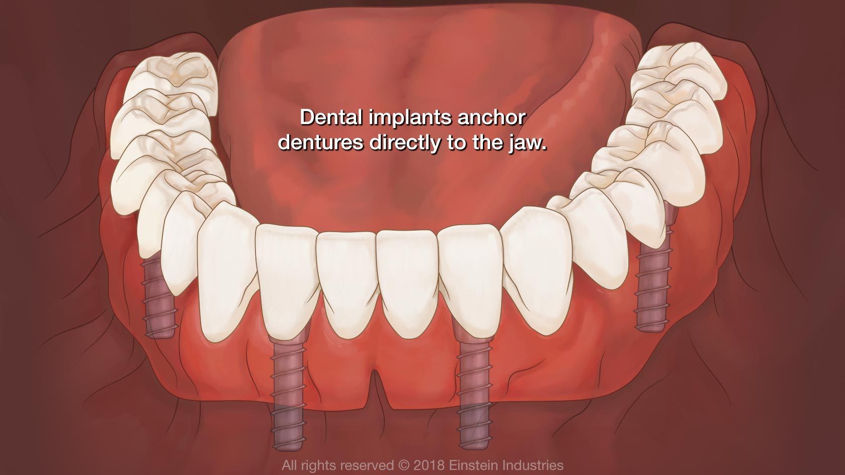 Implant-Supported Dentures