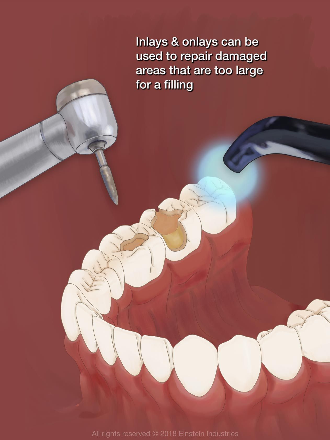 Illustration of inlay and onlay placement