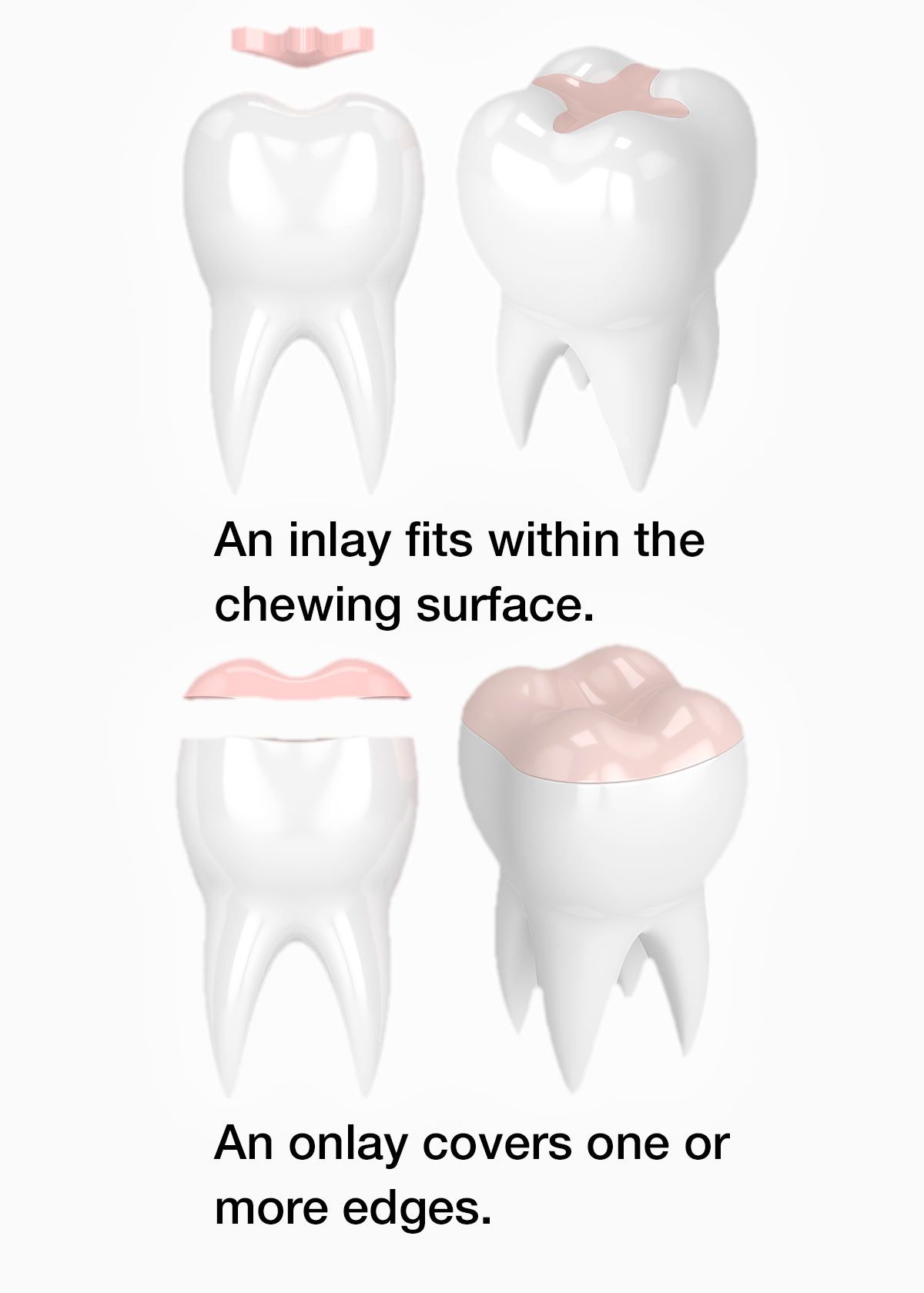 Demonstration of difference between inlay and onlay