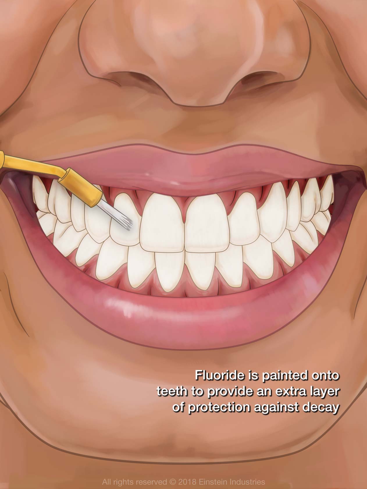 Illustration of fluoride gel as it is applied to smile