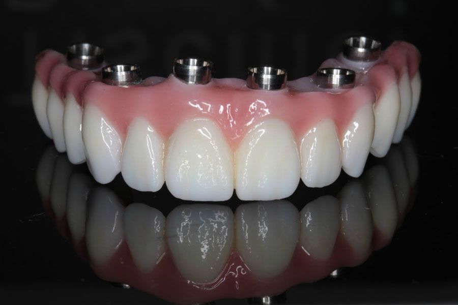 What a Prettau Implant-Supported Bridge Looks Like
